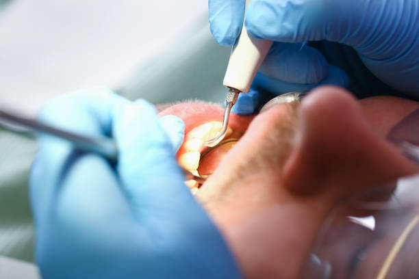 Best Emergency Treatment for Dental Infections or Abscesses in Wellington, KS
