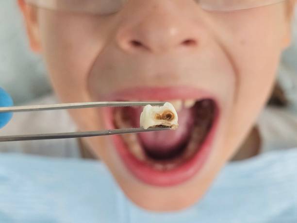 Best Emergency Root Canal Treatment in Wellington, KS